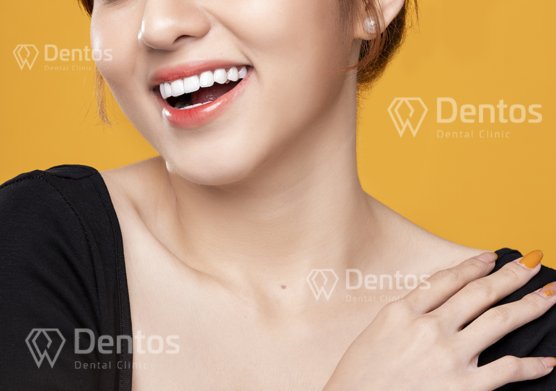 Thẩm mỹ dán sứ Veneer tại Dentos bảo đảm an toàn tuyệt đối